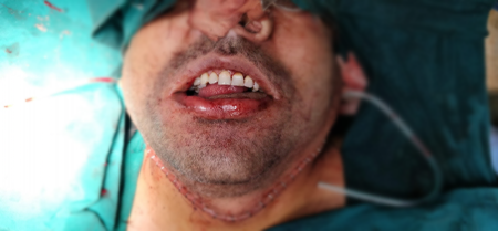 Jaw Bone Cancer Treatment in Hyderabad
